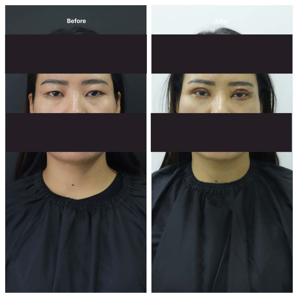 Eyelid Surgery KOQ10